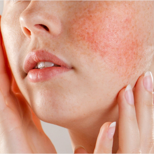 Лечение купероза на лице — самые эффективные варианты